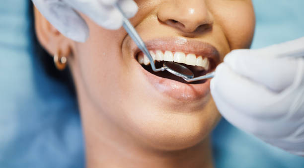 Best Emergency Wisdom Tooth Extraction in Lauderhill, FL